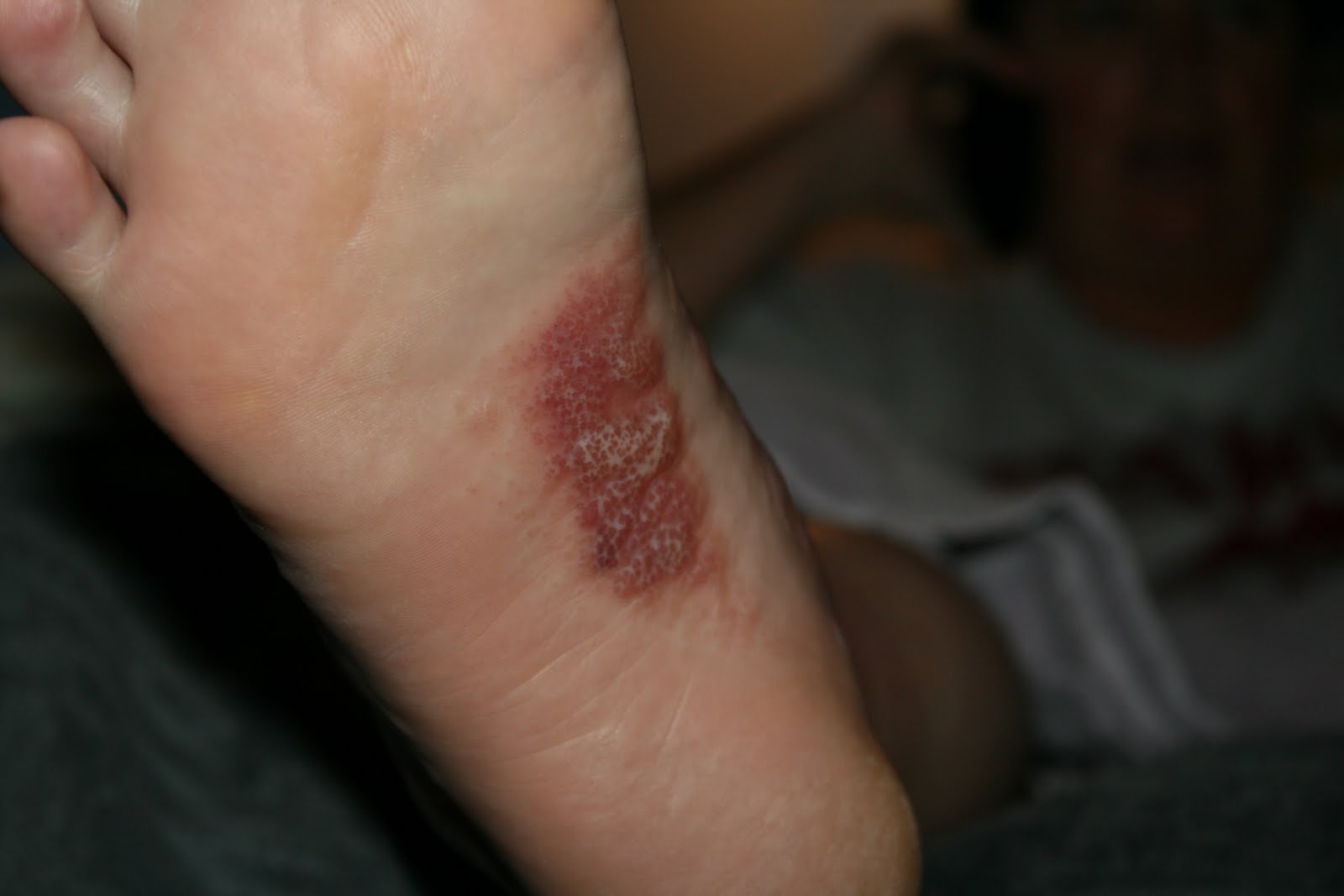 Foot  blisters